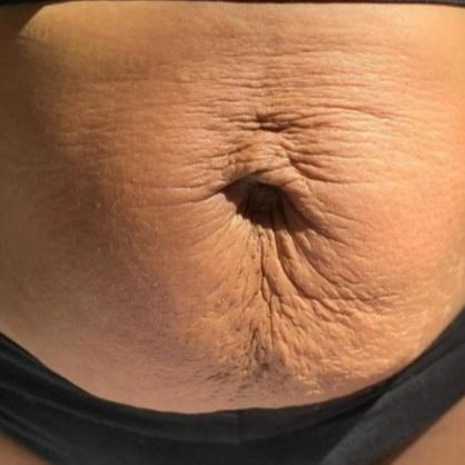 SCAR REMOVAL (LARGE) PKG OF 3