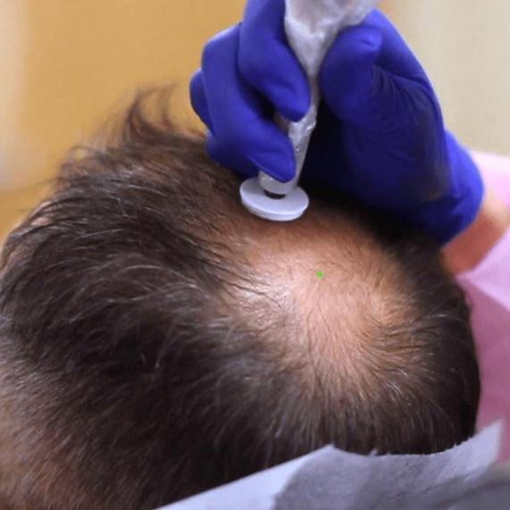 HAIR RESTORATION PACKAGE OF 6